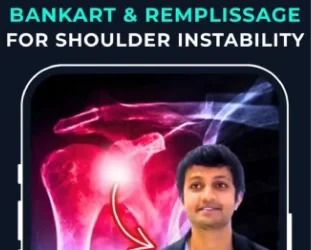 Arthroscopic bankart & Remplissage for Shoulder Instability