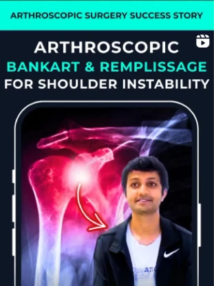 Arthroscopic Bankart and Remplissage for Shoulder