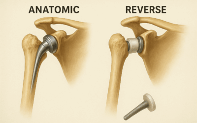 Anatomic vs. Reverse Total Shoulder Replacement: Choosing the Right Option for Your Lifestyle in Bangalore