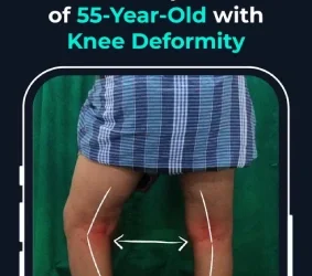 Total Knee Replacement of 55 Year Old with Knee Deformity