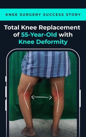 Total knee repalcement of 55 year old man testimonial