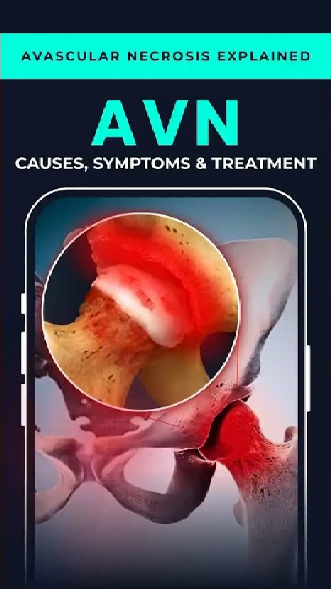 AVN — Understanding a Silent Hip Condition