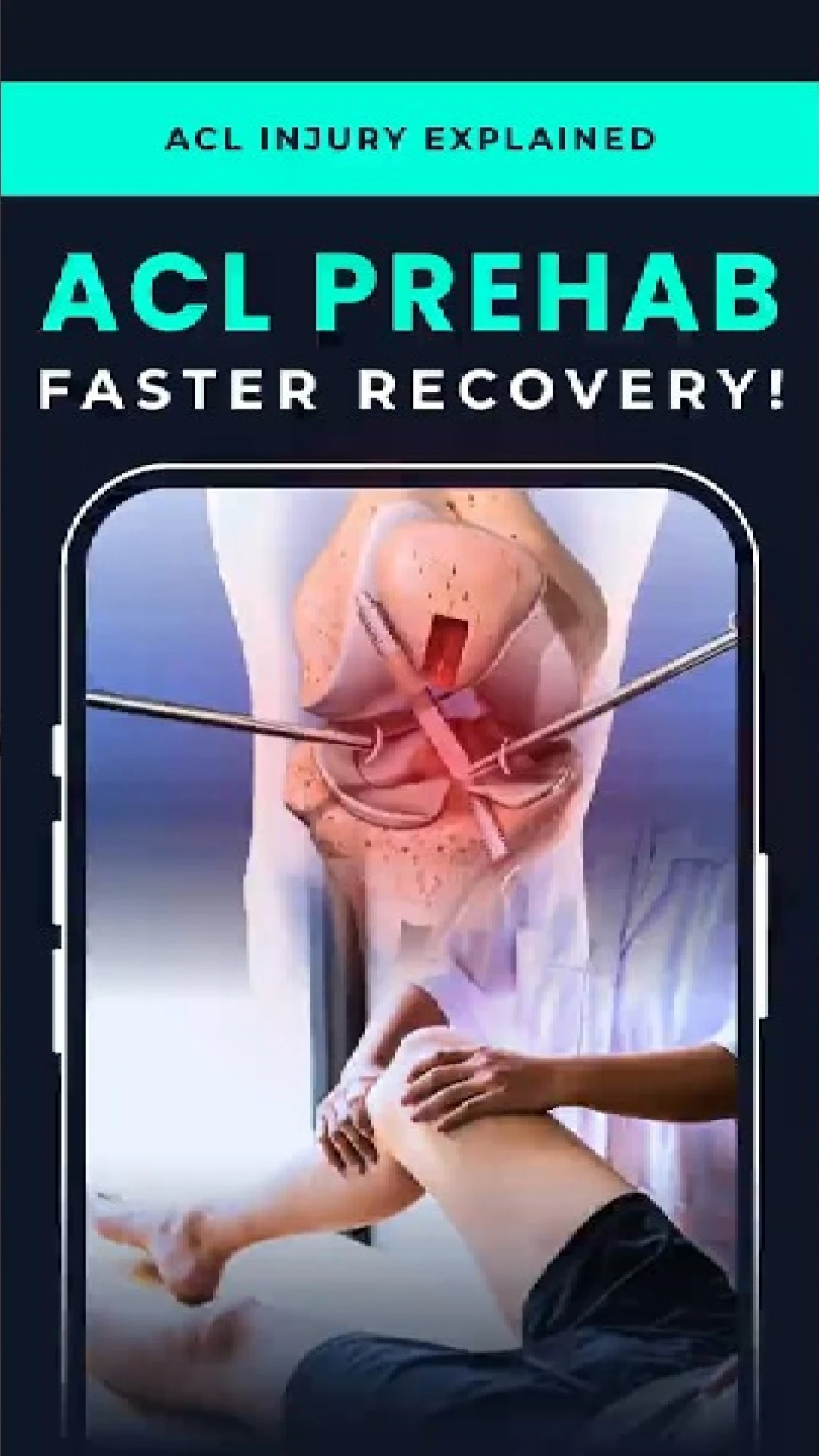 Prehab Before ACL Surgery | The First Step to Recovery