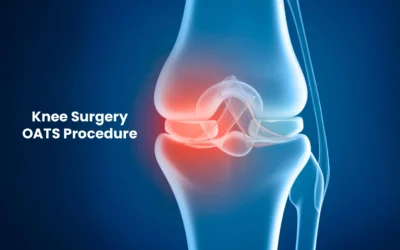 Knee Surgery OATS Procedure: Recovery, Results, and Who Should Consider This Cartilage Repair