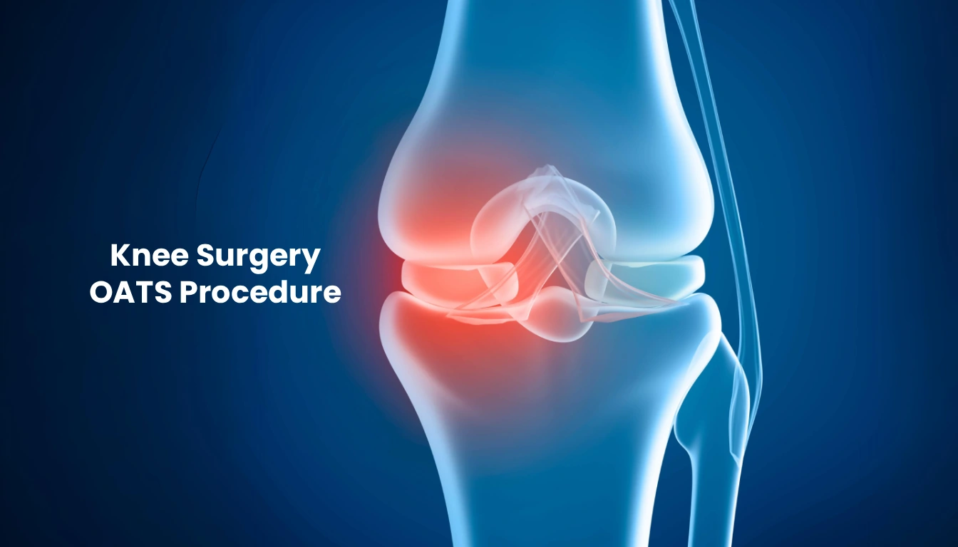 Knee Surgery OATS Procedure Recovery, Results, and Who Should Consider This Cartilage Repair Knee Surgery OATS Procedure Recovery, Results, and Who Should Consider This Cartilage Repair